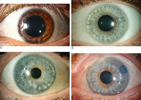 thick cornea good or bad